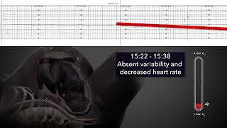Birth Injury Animation - Fetal Distress
