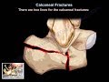 Calcaneal Fractures - Everything You Need To Know - Dr. Nabil Ebraheim