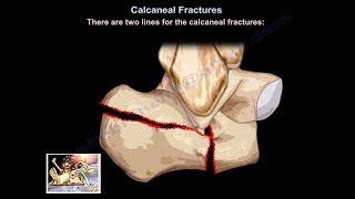 Calcaneal Fractures - Everything You Need To Know - Dr. Nabil Ebraheim