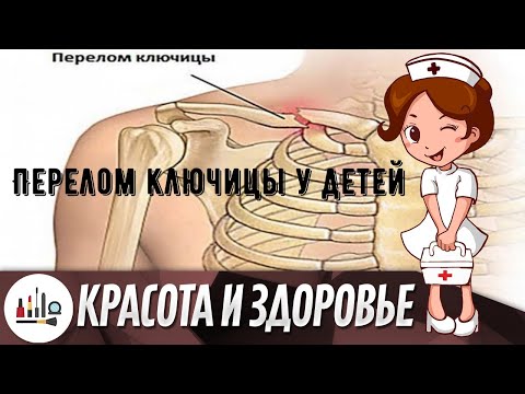 Перелом ключицы у детей