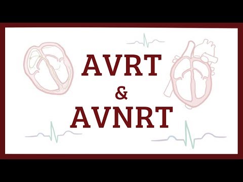 Nhịp tim nhanh vòng-trở-ngược nhĩ-thất (AVRT) và nhịp nhanh vòng-trở-ngược nút-nhĩ-thất (AVNRT)