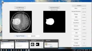 BRAIN TUMOR Detection using image processing in Matlab