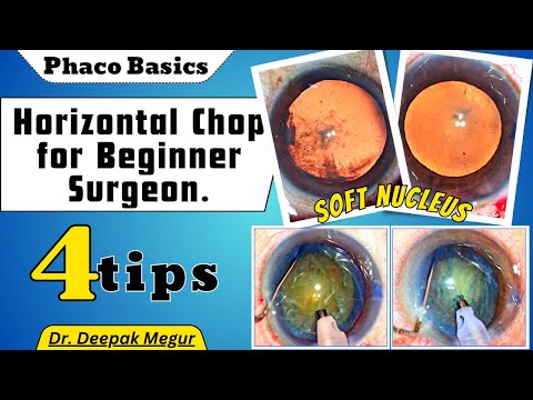 Phaco Basics: Horizontal chop for beginner surgeon (4 tips of Horizontal chop) - Dr. Deepak Megur