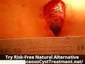 Pilonidal Cyst Removal HUGE HOLE After Barbara A Lamm Pilonidal Cyst Removal HUGE HOLE After Barbara A Lamm
