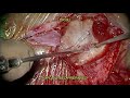 COCHLEAR IMPLANTATION IN MUMBAI - DR.MEENESH JUVEKAR