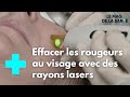 Couperose  sen dbarrasser grce au laser vasculaire  le magazine de la sant