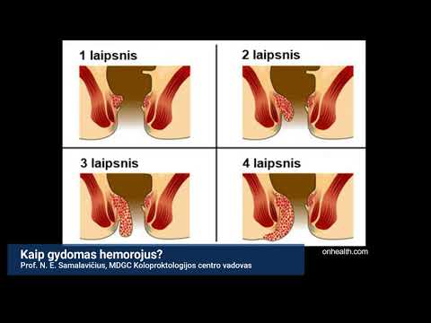 Video: Hemorojus 3 Laipsniai: Gydymas Be Operacijos Namuose, Metodai