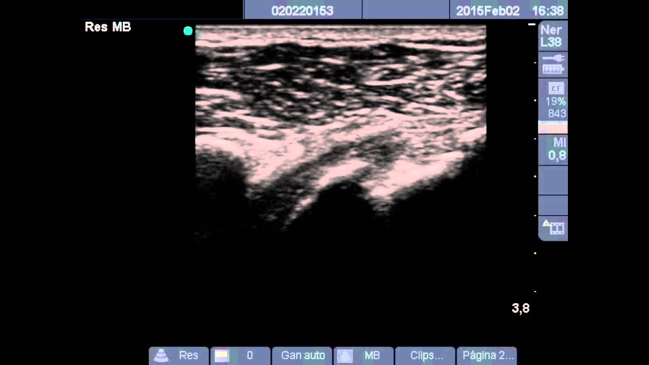 Ecografía clínica en Medicina Familiar. Rotura intrasustancia de supraespinoso.