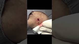 This one kept giving and giving - full video below! #drpimplepopper #dermatology