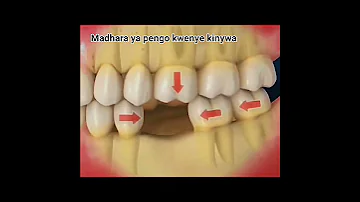 Meno Bandia Kung Oa Jino Daktari Maumivu Uchumi Hospitali Solution Me Uislamu 