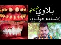 مخاطر ومصايب وبلاوي إبتسامة هوليوود/تجربتي ٣ مرات