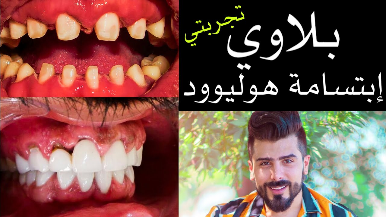 مخاطر ومصايب وبلاوي إبتسامة هوليوود تجربتي ٣ مرات Youtube