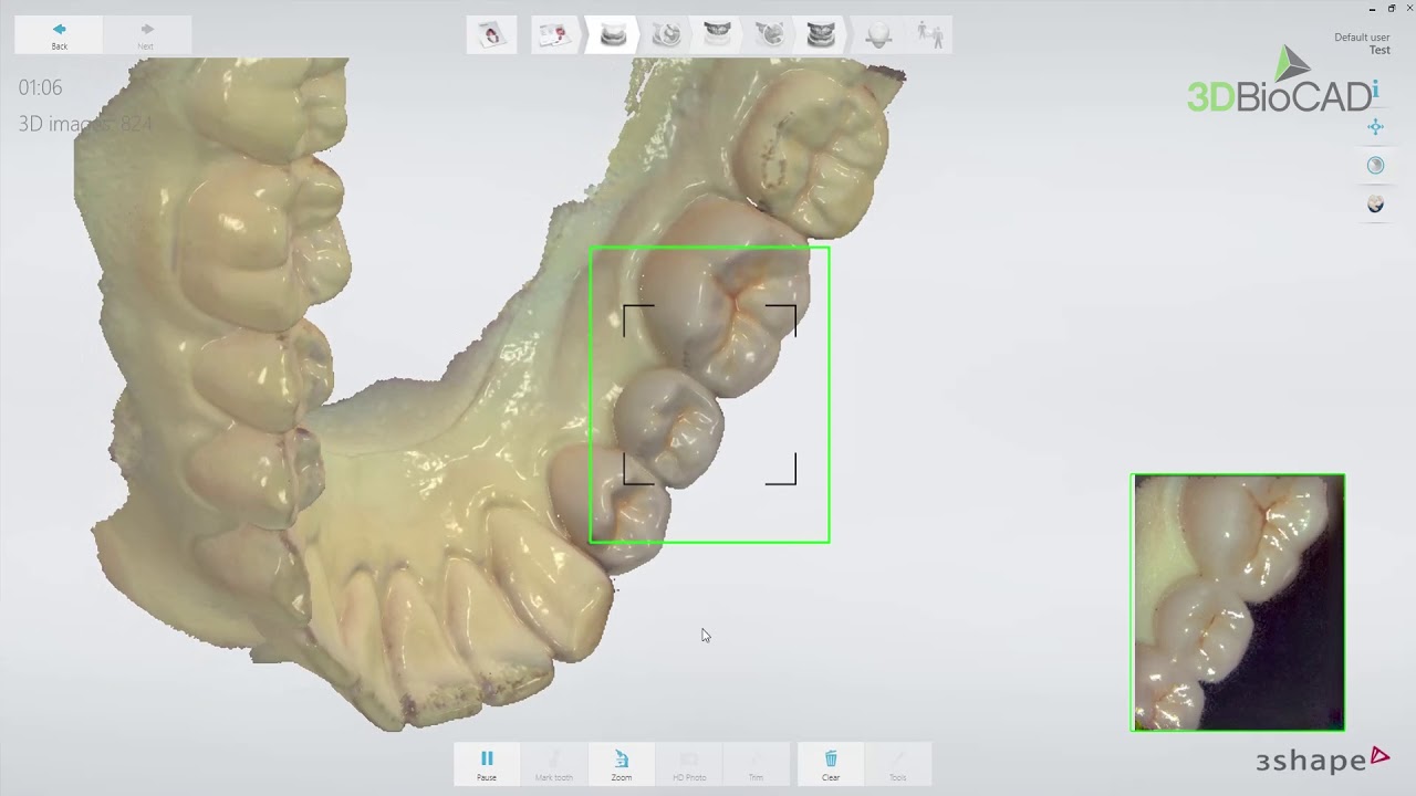 3DBioCAD - TRIOS crown and bridge workflow