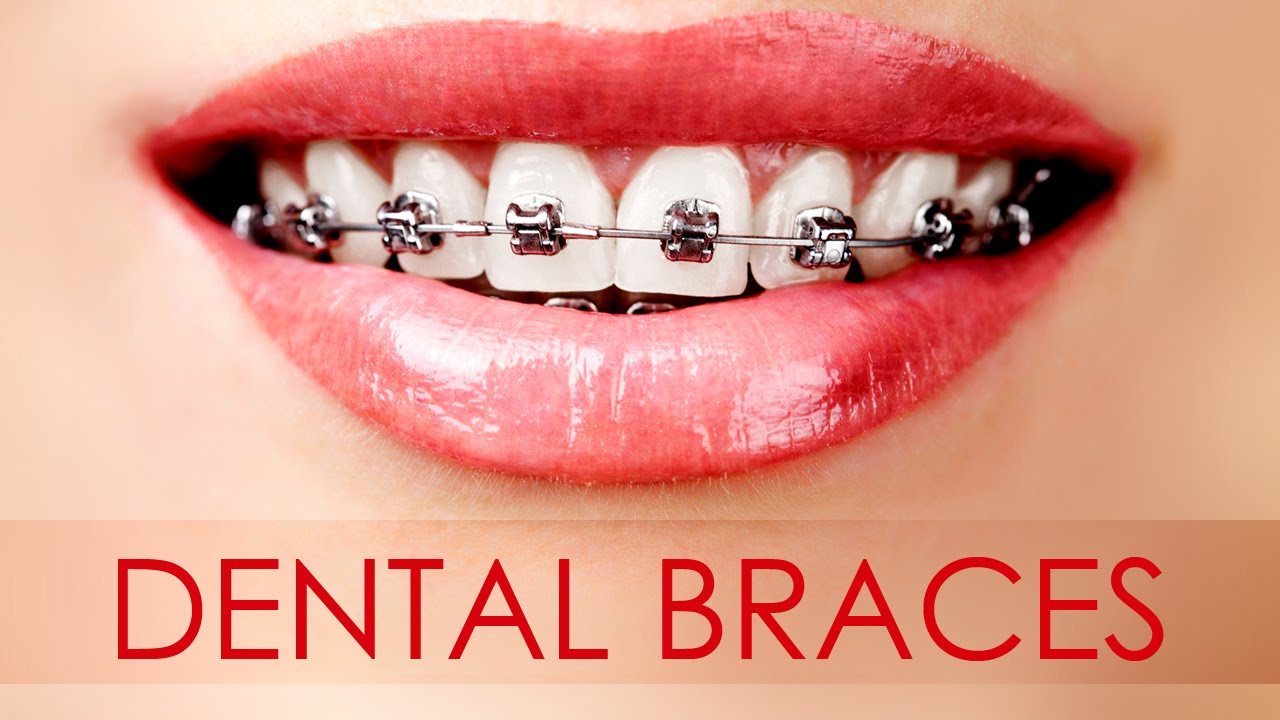 Image result for Dental Braces image
