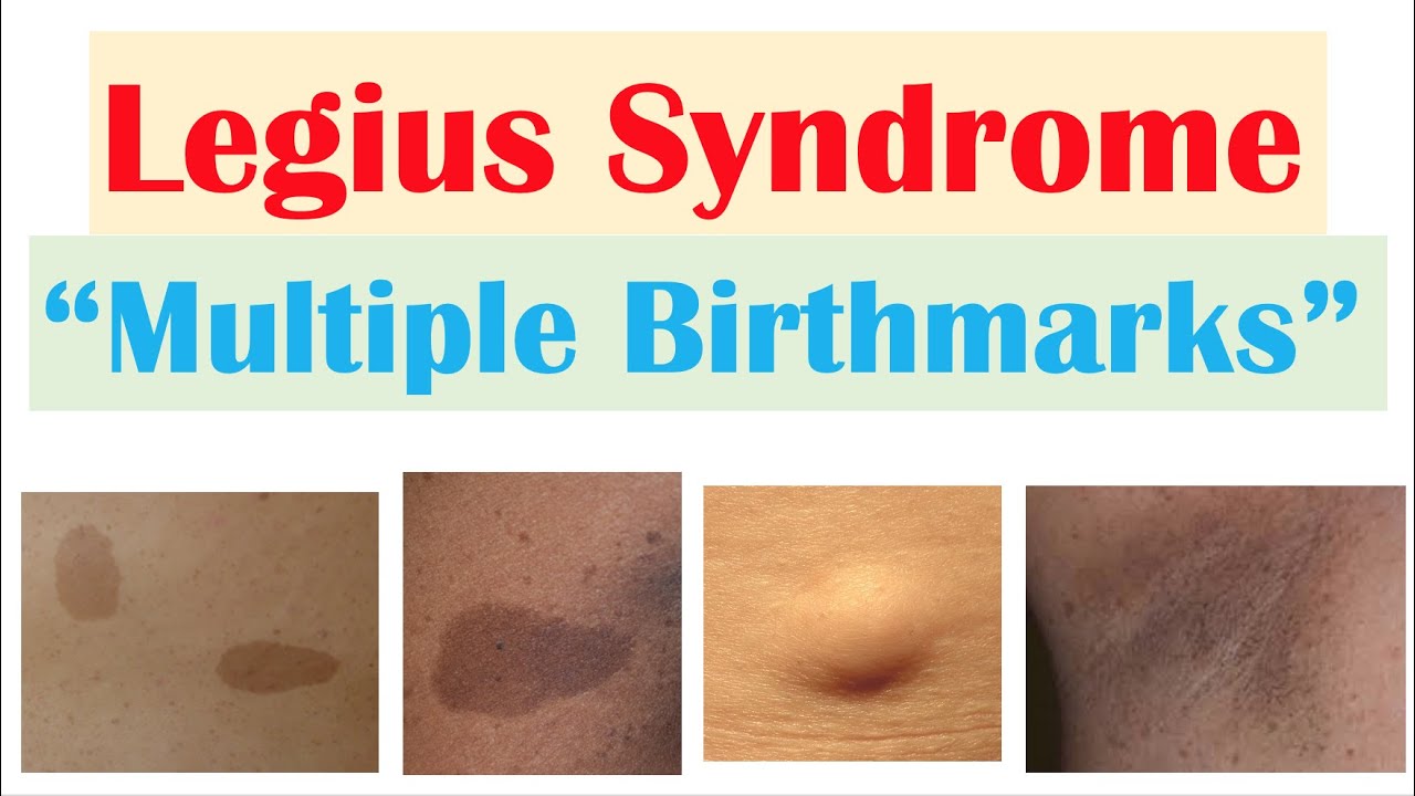 “Inherited Condition with Many Birthmarks” | Legius Syndrome | Symptoms, Diagnosis, Treatment