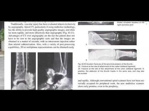 Videó: Circumscripta volt a calcinosis?