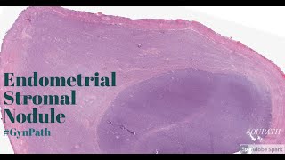 Endometrial Stromal Nodule