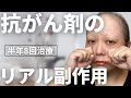 乳がんの抗がん剤治療で経験した副作用がつらすぎました【37歳で乳がんステージ2】
