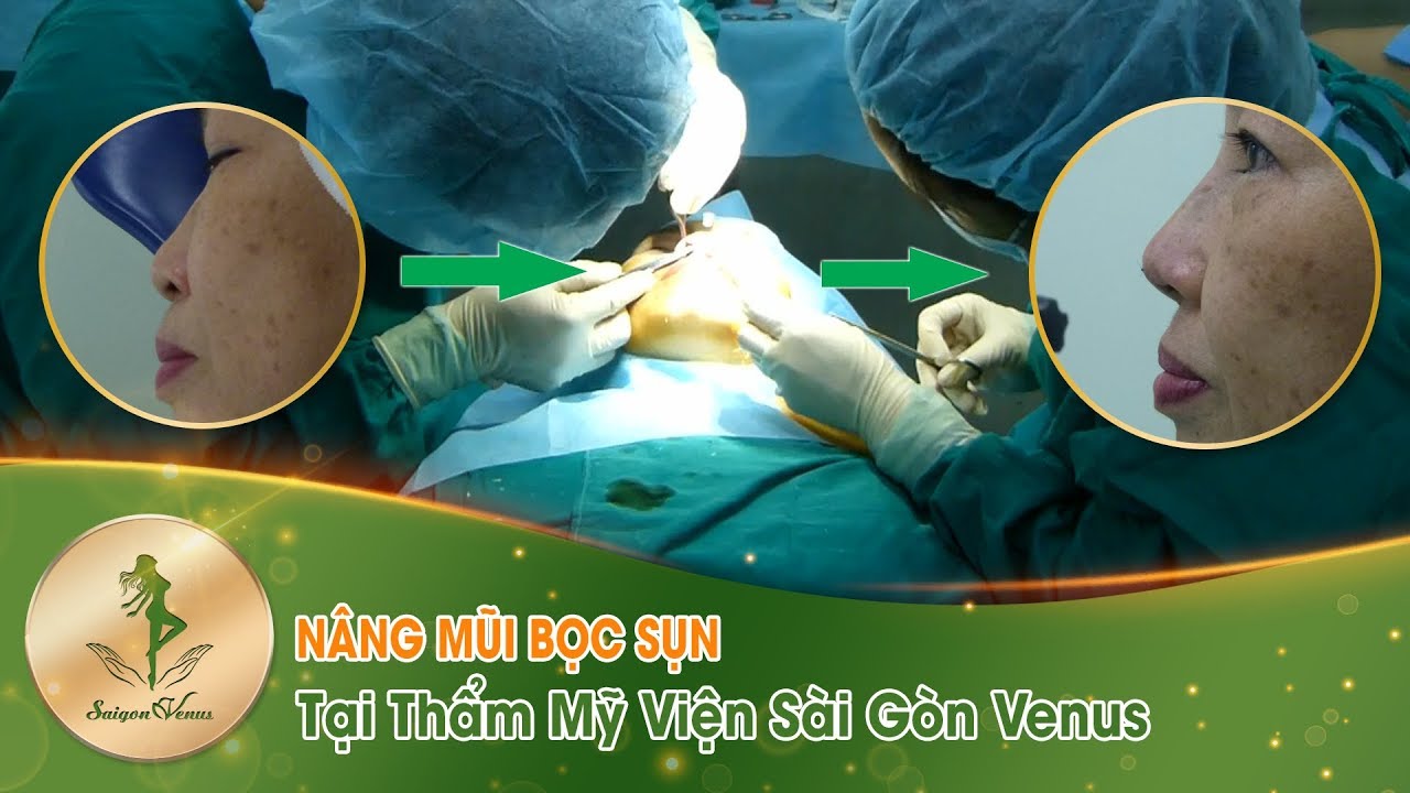 Cận cảnh phòng mổ quá trình Nâng Mũi Bọc Sụn - Viện Thẩm Mỹ Sài gòn Venus - Hotline 0919 205511 - YouTube