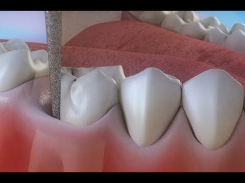 牙髓治疗 — 治疗深度蛀牙 ©