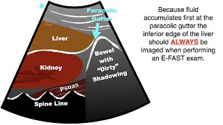 POCUS:  EFAST - Progression free fluid in the Right Upper Quadrant (RUQ)