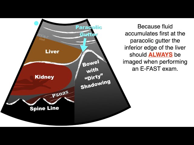 POCUS:  EFAST - Progression free fluid in the Right Upper Quadrant (RUQ) class=