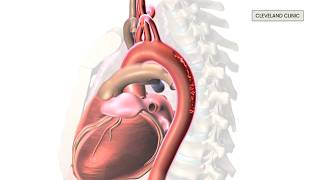 What is aortic dissection