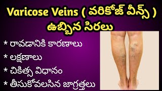 Varicose Veins Causes , Symptoms and Treatment in Telugu | వరికోజ్ వీన్స్ | ఉబ్బిన సిరలు