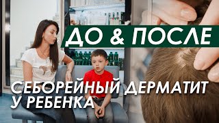 ДО & ПОСЛЕ: У Ребенка Себорейный Дерматит ЧТО ДЕЛАТЬ - Перхоть у детей - РЕАЛИТИ ORising