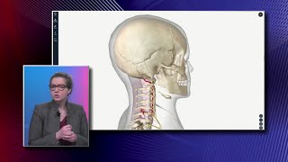 Cervical Herniated Disc