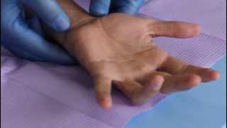 How to Perform a Modified Allen's Test