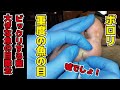 【嘘みたい】長年苦しんだ魚の目の痛みが、たった一度の施術で劇的に改善！
