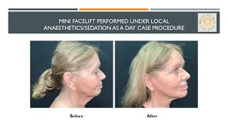 MiniFacelift performed at MACS Clinic under local anaesthetics/sedation
