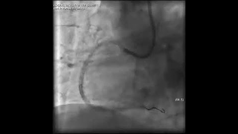 Complex PCI for RCA CTO with bifurcation at distal cap video 18