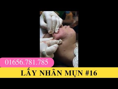 Lấy nhân mụn - Mụn ẩn - Điều trị mụn #16 - Mỹ phẩm thuốc bắc D'Vi Beauty