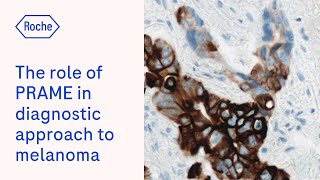 The role of PRAME immunohistochemistry in the diagnostic approach to melanocytic lesions