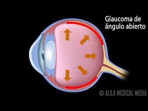 Glaucoma de Ángulo Abierto y de Ángulo Cerrado, Animación. Alila Medical Media Español.