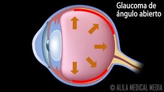 Glaucoma de Ángulo Abierto y de Ángulo Cerrado, Animación. Alila Medical Media Español.