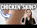 Do You Have Keratosis Pilaris or Something Else?