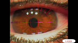 Precio miopia y astigmatismo cirugia laser
