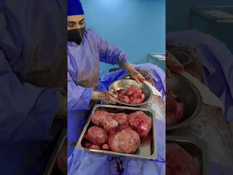 استئصال ٤٠ ورم مع الحفاظ علي الرحم سليم ومعافي د البنا مصر من في الي الخير قل اعوذ برب الفلق