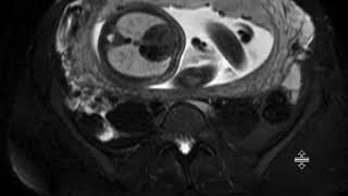 Pregnant appendicitis