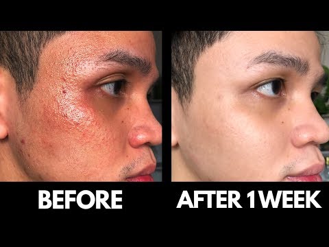 HOW TO CURE FUNGAL ACNE IN JUST ONE WEEK!