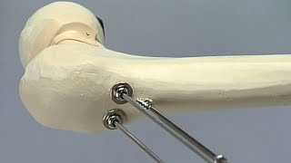 Femoral Neck - Fracture - Fixation Using the 7.3 mm Cannulated Screw