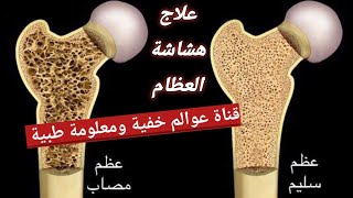 علاج هشاشة العظام.