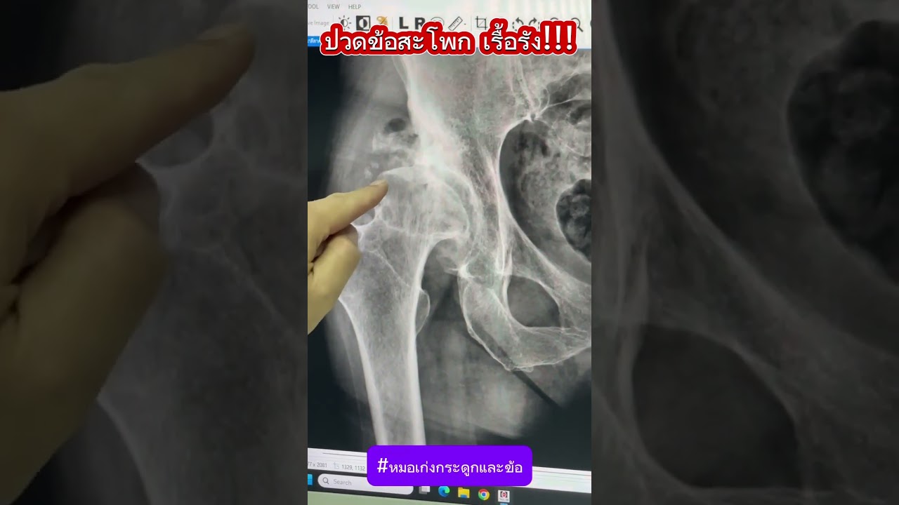 ปวดข้อสะโพก เรื้อรัง!!!