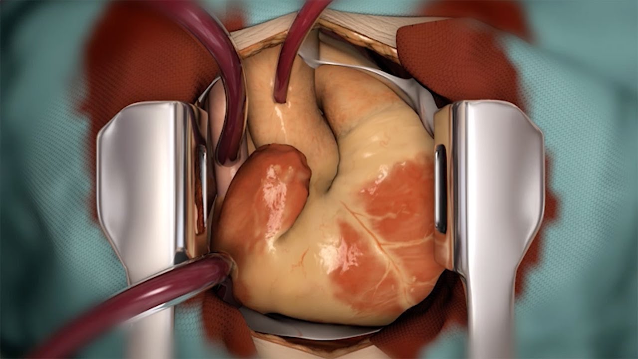 Heart Transplantation - a treatment for heart failure - YouTube