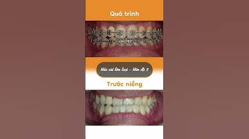 Hành trình LỘT XÁC nhờ niềng răng của Hoàng Thanh