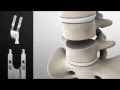 Artificial Lumbar Disc Replacement | BISI