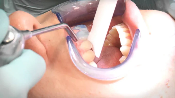 Bozek Orthodontics: Putting Your Braces On